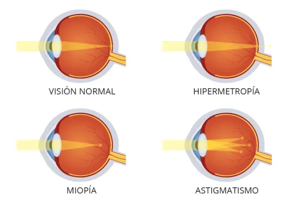 Trastornos Visuales y su Diagnóstico ¿Qué son?