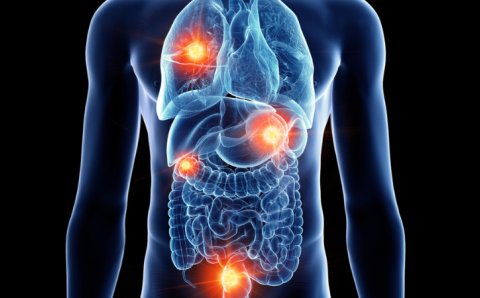 estudio-elbosque-nodulos-pulmonares-cancer-metastasis