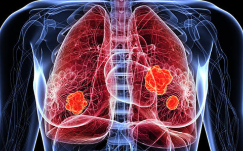 tesis-laureada-universidad-elbosque-nodulos-pulmonares-cancer